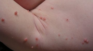Molluscum contagiosum of the arm