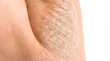 Eczema