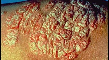 Psoriasis