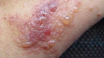 Poison Ivy Rash
