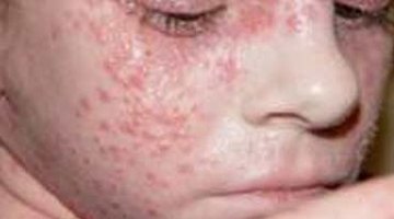 Atopic Dermatitis
