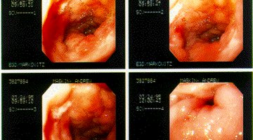 Ulcer