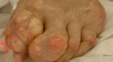 Gout in the foot can be both painful and disfiguring.