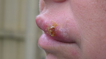 La costra es la última etapa en la curación del herpes labial.