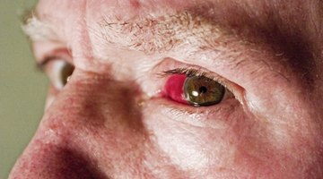 Las lentes de contacto pueden causar condiciones serias que requieren el tratamiento de un médico.