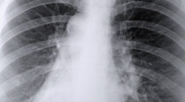 Una radiografía del tórax puede ayudar a determinar si tienes una infección por ingestión de alimentos.