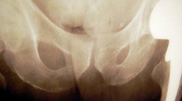 El cáncer de hueso suele afectar a la cadera y al fémur.