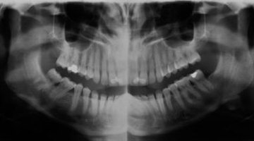 Radiograph showing that 28 teeth are present