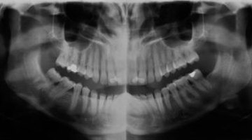Radiogram pokazujący, że 28 zębów jest obecnych