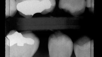 Bitewing X-rays help to illustrate decay between two teeth.