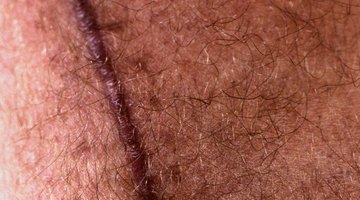 ¿Qué puedo hacer para aplanar una cicatriz queloide?
