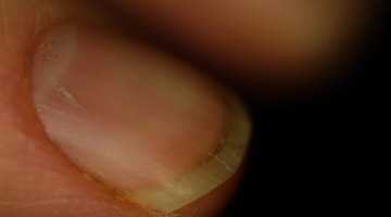¿Qué causa las ondulaciones en las uñas?