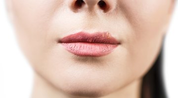Qué causa pequeños bultos blancos en los labios