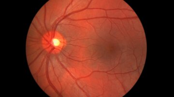 Desprendimiento de retina: síntomas y tratamiento