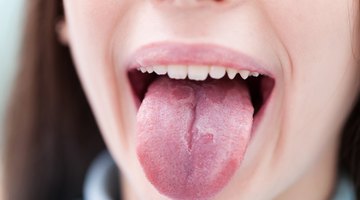 Causas de bultos grandes en la parte de atrás de la lengua
