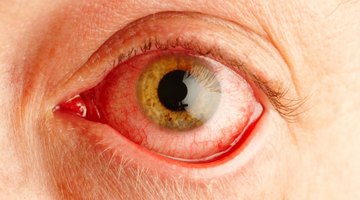 Las causas de la decoloración del ojo
