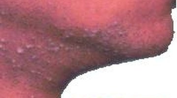 Treatment for an Old Scar Itch | Healthfully