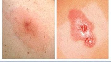 mercers disease