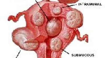 Natural Treatment For Fibroids After Menopause Natural Treatment For Fibroids After Menopause