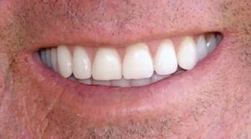 The Difference Between Porcelain Teeth & Acrylic Teeth | Healthfully