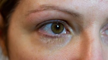 Signs & Symptoms of a Cold Sore in Your Eye | Healthfully