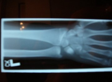X-ray image of the forearm