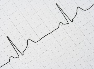 The waveform from an EKG machine.