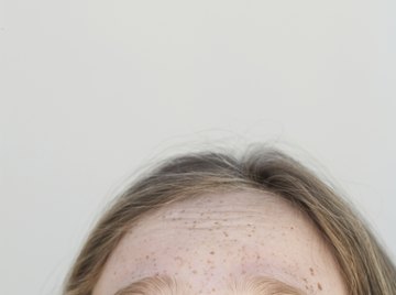 Freckles are an inherited dominant gene trait.