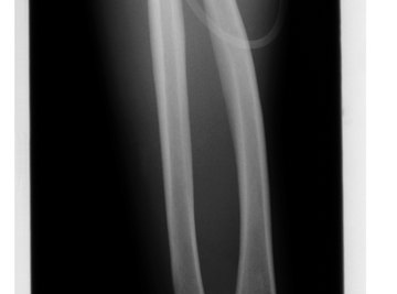 Pivot bones such as the radius and ulna allow for circular movement.
