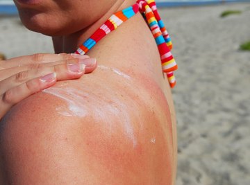 Got too much sun? Your skin is angry!
