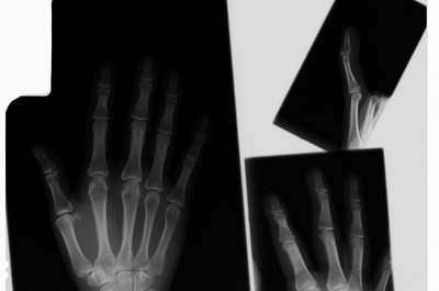 Thinkstock/Comstock/Getty Images Break your finger at work and you may get workers' compensation benefits.