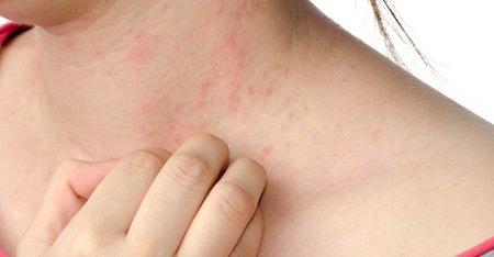 Causas de sarpullido en el cuello | Muy Fitness