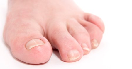 ¿Qué significan las rugosidades en las uñas de los pies ...