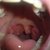 About Chronic Cryptic Tonsils