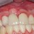 About Failed Dental Implants
