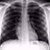 What Does a Smoker's X-Ray Look Like?