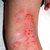 What Foods Can Cause Eczema?