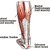 Symptoms of a Torn Achilles Tendon