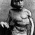 What Are the Symptoms of Elephant Man Disease?