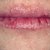 What Causes Cracked Split Lips?