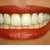 How Do Dentists Clean Teeth?
