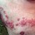 Why Do I Have Recurring Shingles?