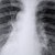 What Is Consolidation in the Lungs?