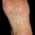 Hypothyroid Foot Pain