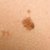Folk Remedies for Removing Moles & Skin Tags at Home