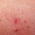 The Best Scabies Treatment