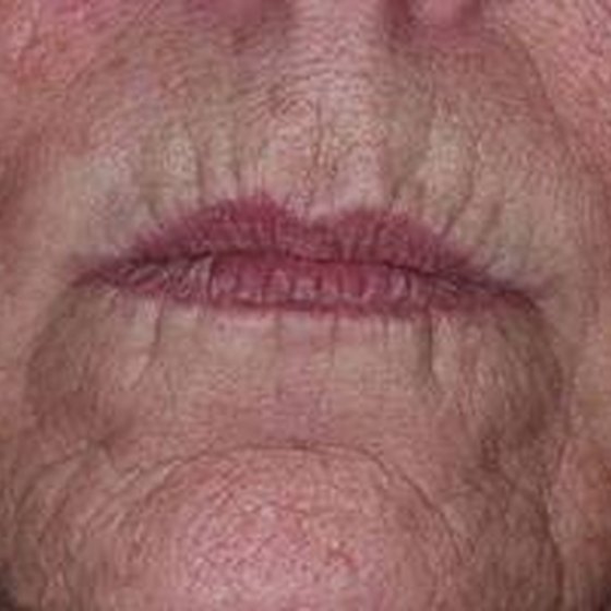 how-to-get-rid-of-smoker-wrinkles-healthy-living