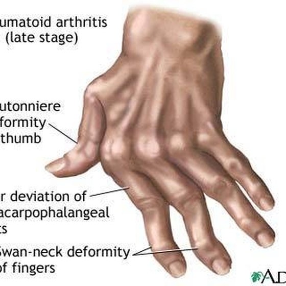 Stages Of Rheumatoid Arthritis Healthy Living