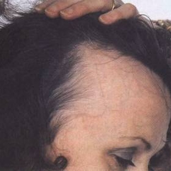 woman with receding hairline