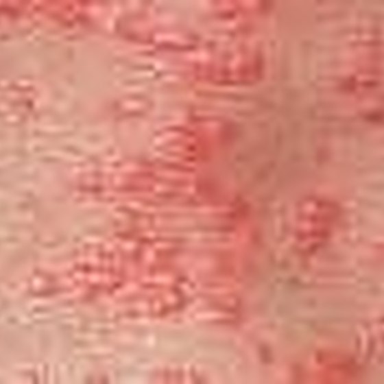 how-to-recognize-and-treat-scabies-healthy-living